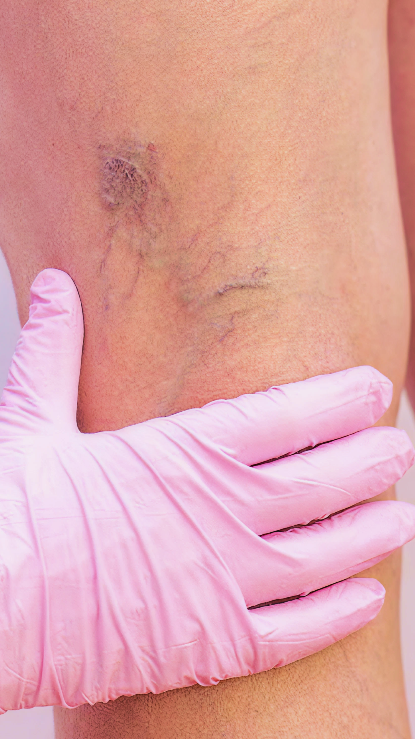 Procedimento Estético Injetável em Microvasos